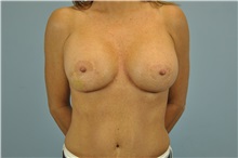 Breast Reconstruction Before Photo by Paul Vanek, MD, FACS; Concord, OH - Case 32799