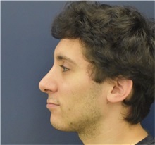 Rhinoplasty After Photo by Richard Reish, MD, FACS; New York, NY - Case 36265