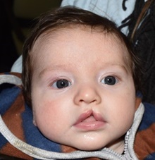 Cleft Lip and Palate Repair Before Photo by Rachel Ruotolo, MD; Garden City, NY - Case 42042