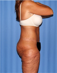 Body Lift Before Photo by Siamak Agha, MD PhD FACS; Newport Beach, CA - Case 43862