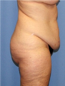Body Contouring Before Photo by Siamak Agha, MD PhD FACS; Newport Beach, CA - Case 44053