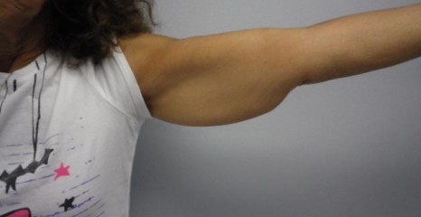 Arm Lift Before