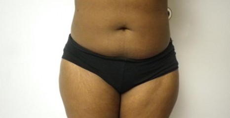 Female Belly Liposuction After