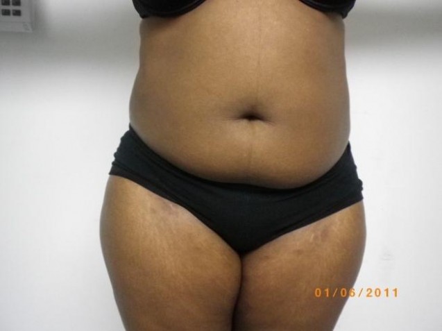 Female Belly Liposuction Before