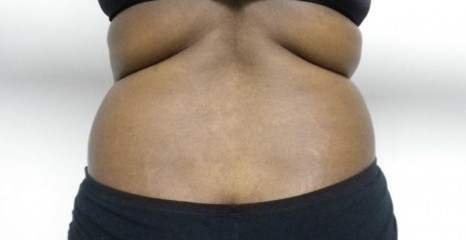 Female Waist Liposuction Before