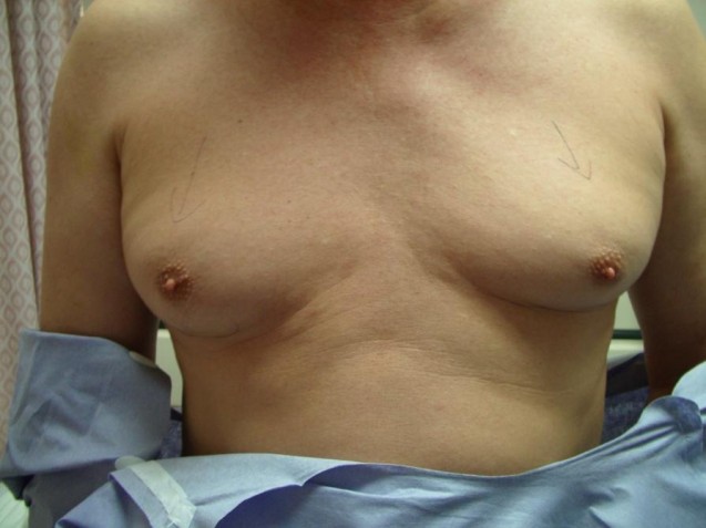 Male Liposuction Before