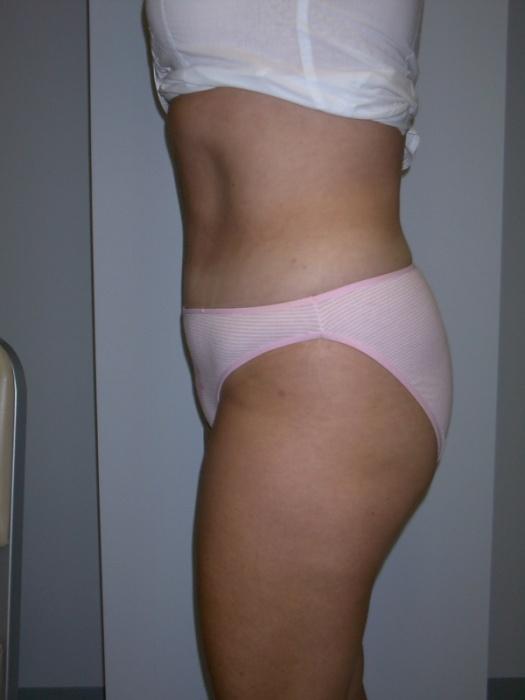 Tummy Tuck 2 After